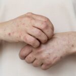 Bele mrlje na koži: simptomi, uzroci i tretmani Vitiliga