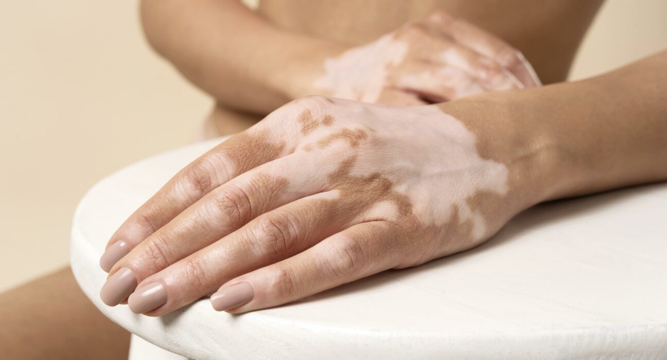 Vitiligo bolest koze