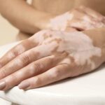 Male boginje – ozbiljna virusna infekcija koja se i dalje širi