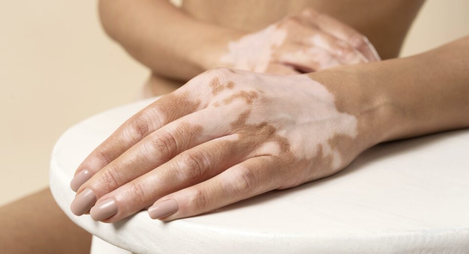 Vitiligo bolest koze