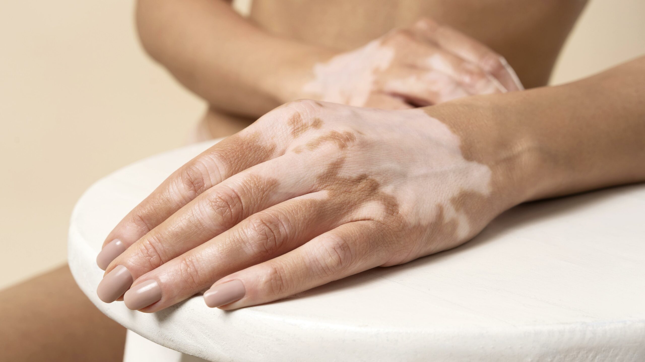 Vitiligo bolest koze