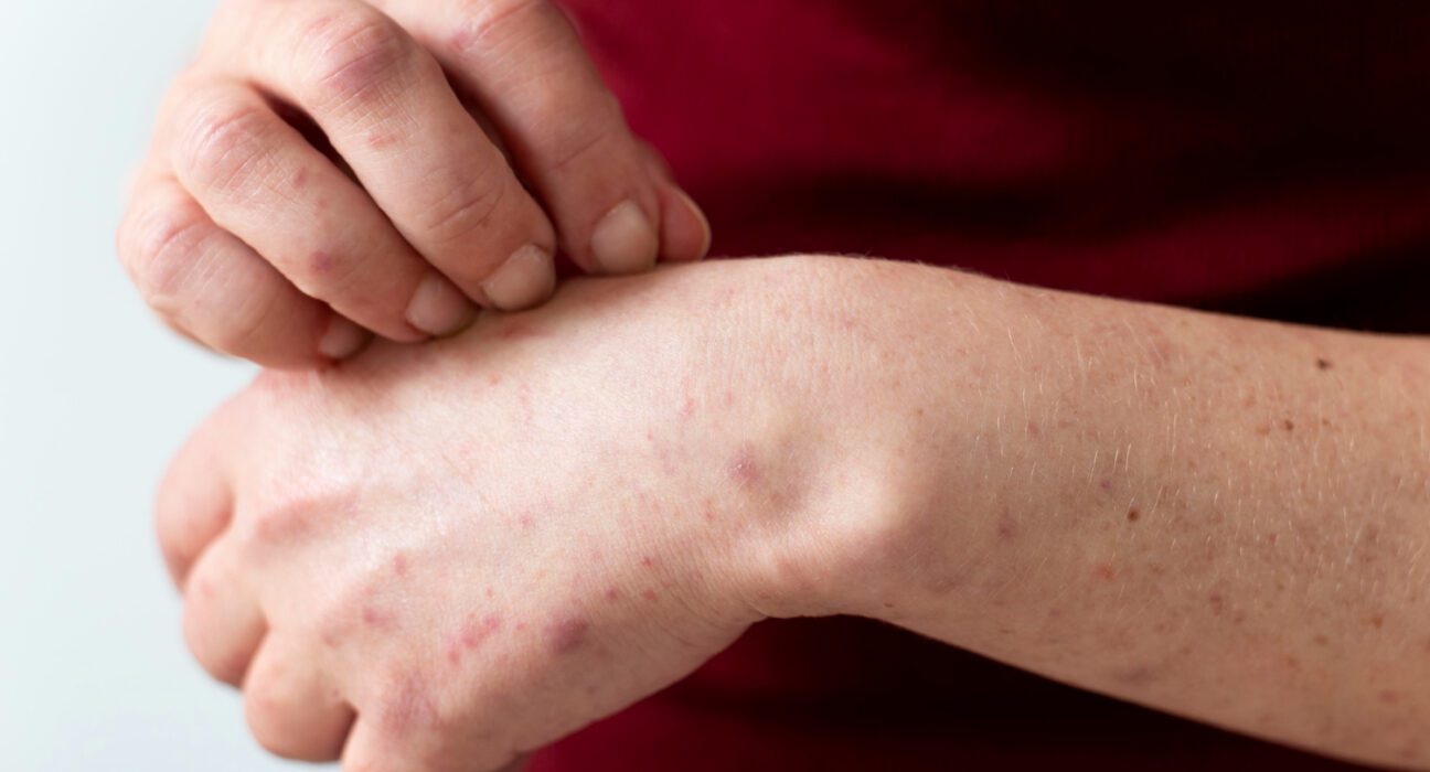 Lupus i iritacije koze