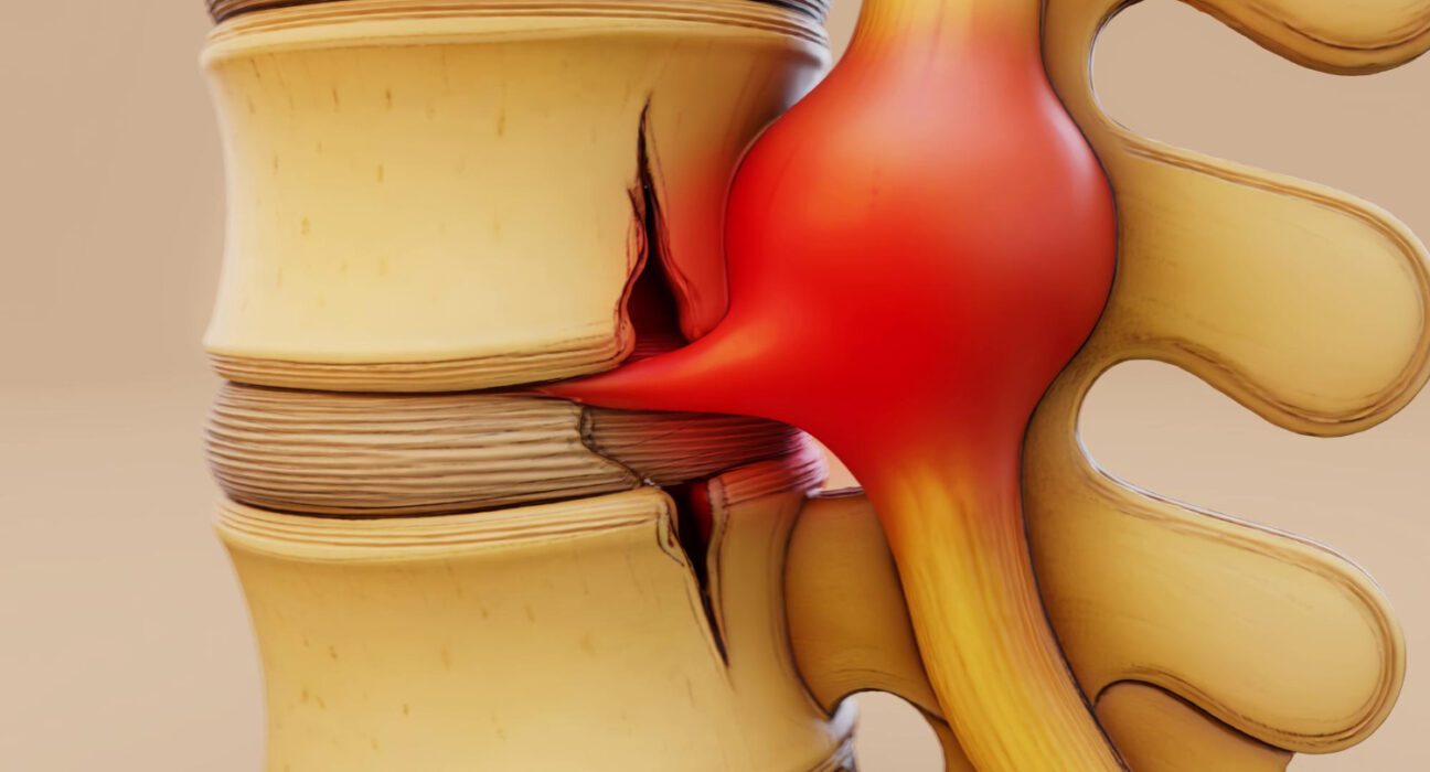 Diskus hernija i ukljestenje kicmenog diska