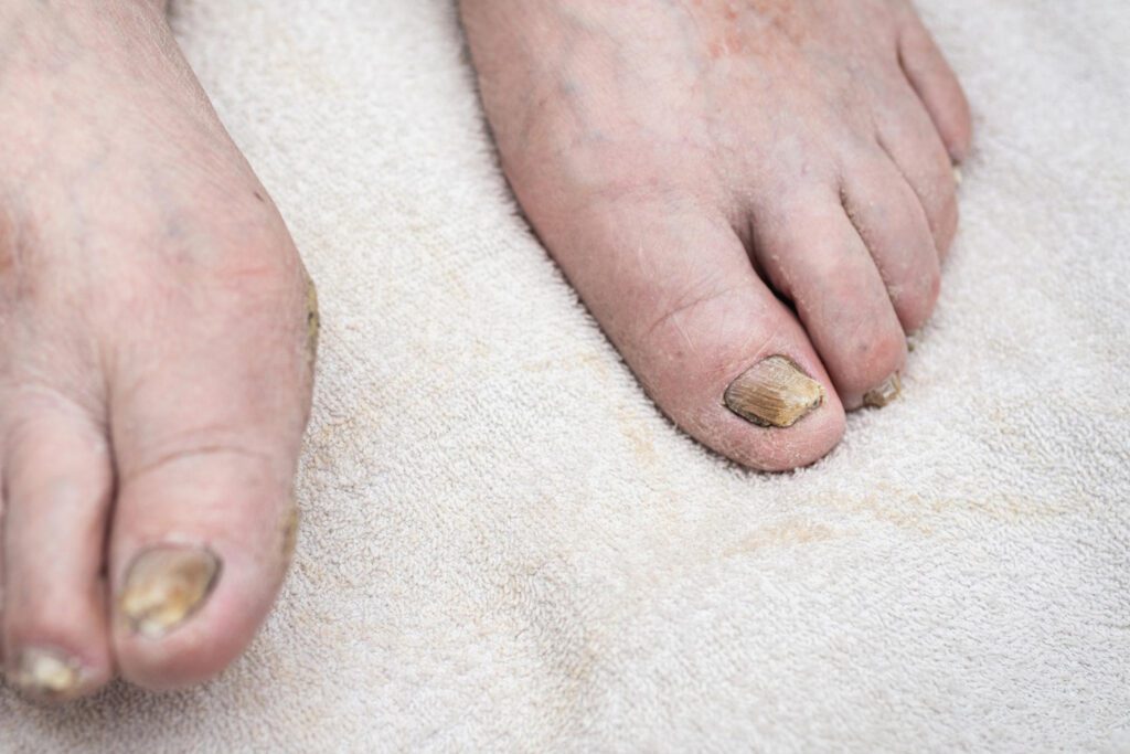 Gljivicna oboljenja stopala