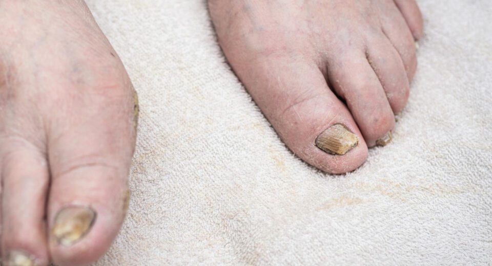 Gljivicna oboljenja stopala