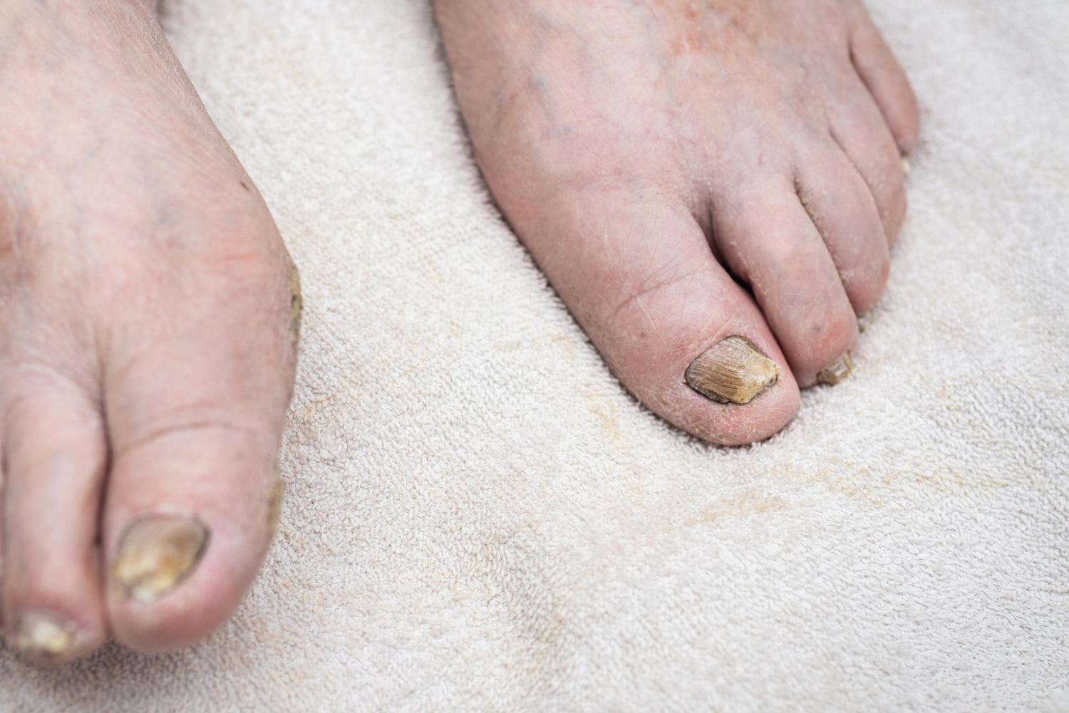 Gljivicna oboljenja stopala